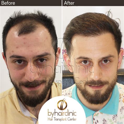 best hair transplant istanbul turkey.